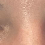 Upneeq Eye Drops Treatment Before