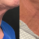 Morpheus8 Face Neck Before & After Results Female