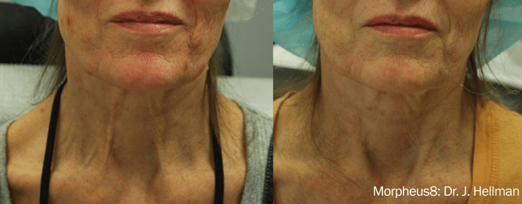 Morpheus8 Face Neck Before & After Results Female