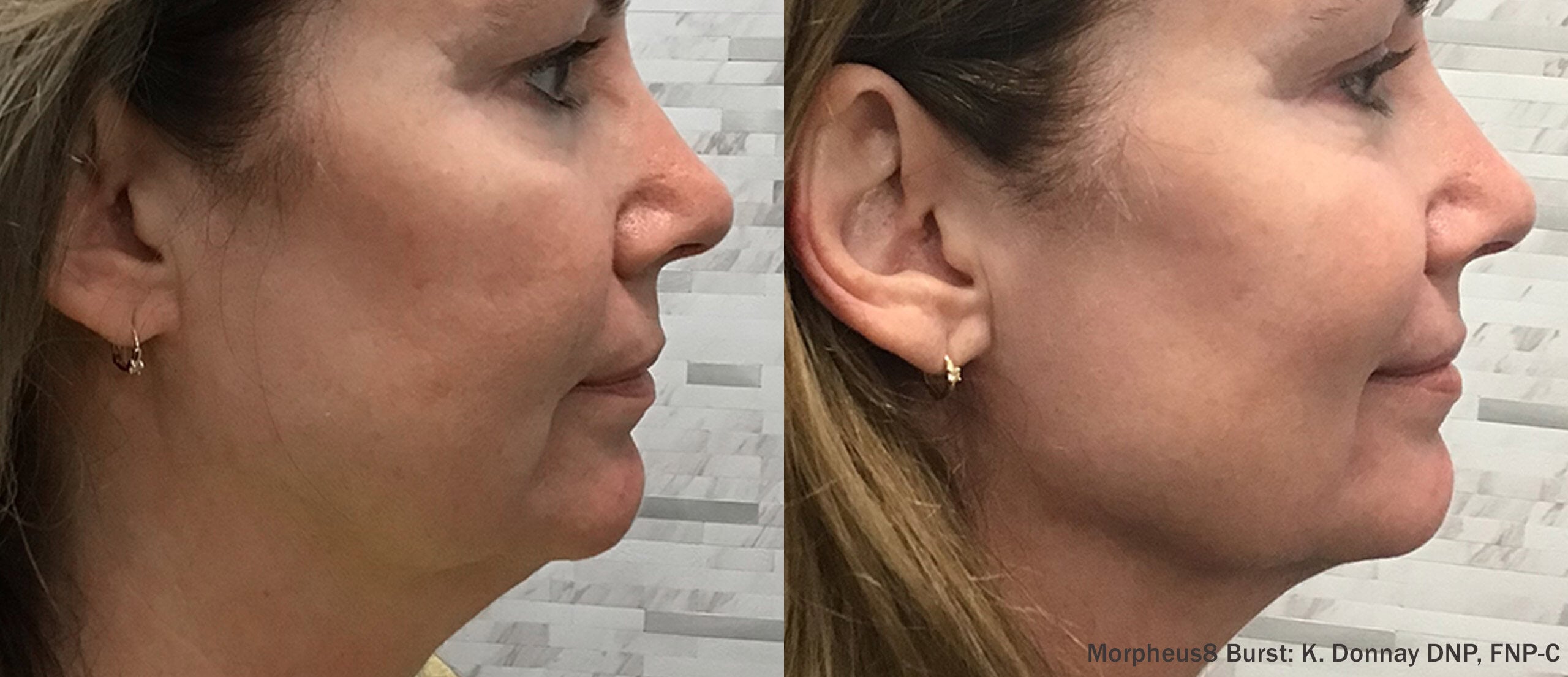 Morpheus8 in Colorado Springs with Burst 2.0 technology before and after results for face and neck skin tightening in Colorado Springs